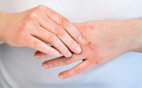 乳膠手套能否有效防止長(zhǎng)水泡？